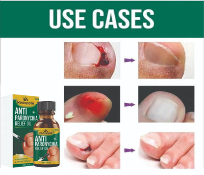 Anti Paronychia Relief Oil: Buy 1 Get 1 Free!