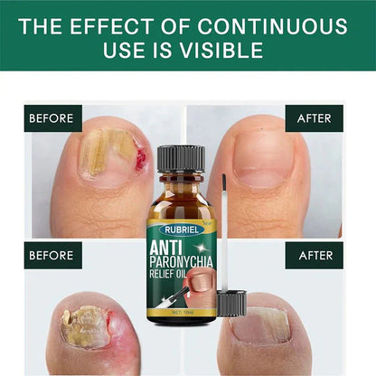 Anti Paronychia Relief Oil: Buy 1 Get 1 Free!